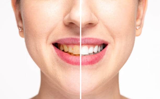 Teeth Whitening Milton Keynes Cambridgeshire