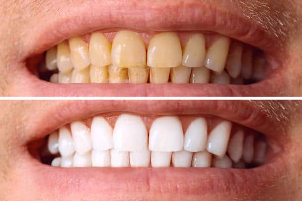 Laser White For Ever Bright – Get a Brighter, Whiter Smile with LA Teeth Whitening Cambridgeshire