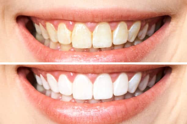 Achieve a Dazzling Smile for Your Special Day: A Guide to Wedding Teeth Whitening Cambridgeshire