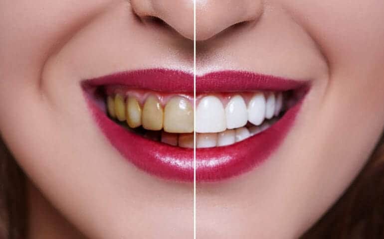 Teeth Whitening Ascot Windsor Cambridgeshire