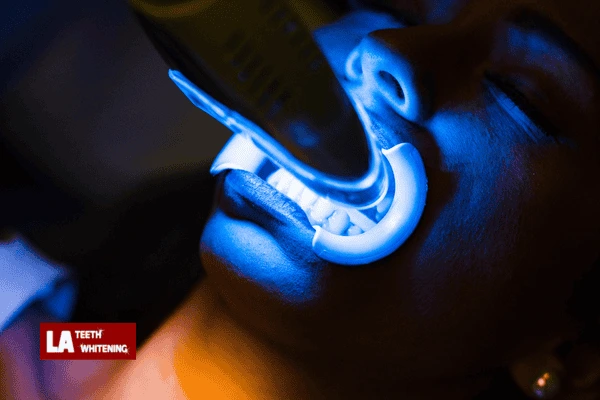 How long does laser whitening Cambridgeshire Take? Cambridgeshire